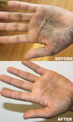 Eczema Relief